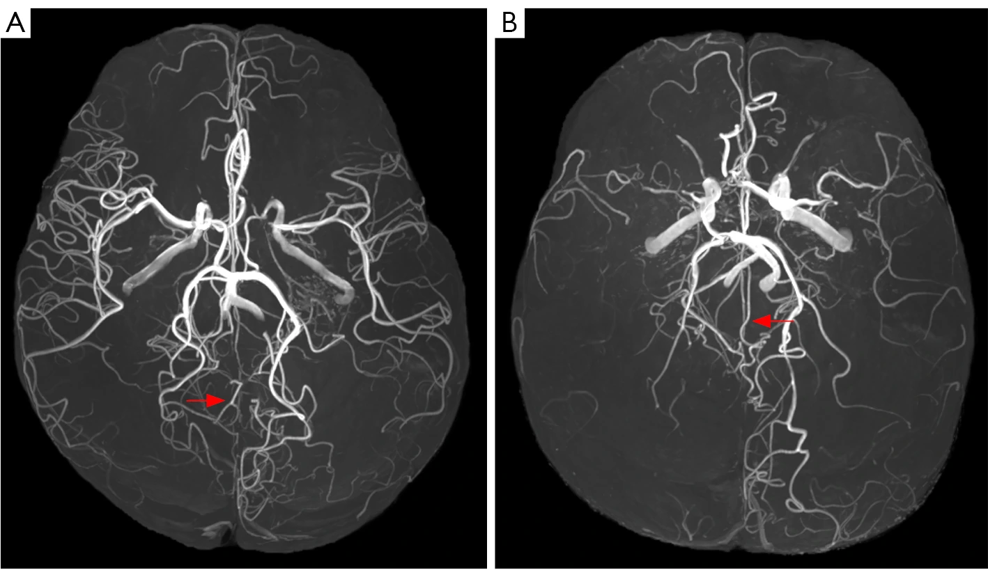 Figura clínica publicada con dos angiografías por resonancia en las que se señalan anastomosis entre los territorios de la arteria cerebral posterior y la anterior.