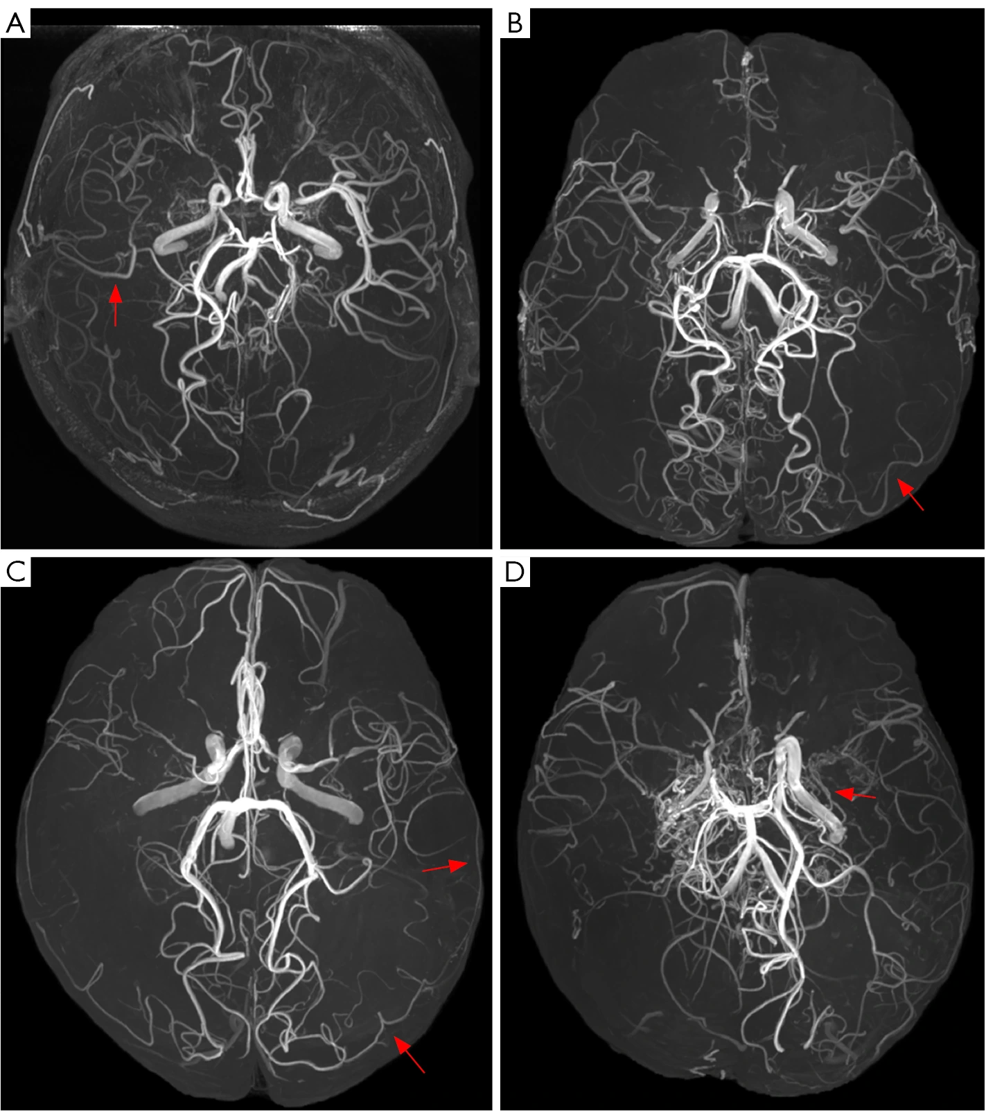 Cuatro angiografías por resonancia de la cohorte publicada, con flechas que señalan anastomosis entre los territorios de la arteria cerebral posterior y la media.
