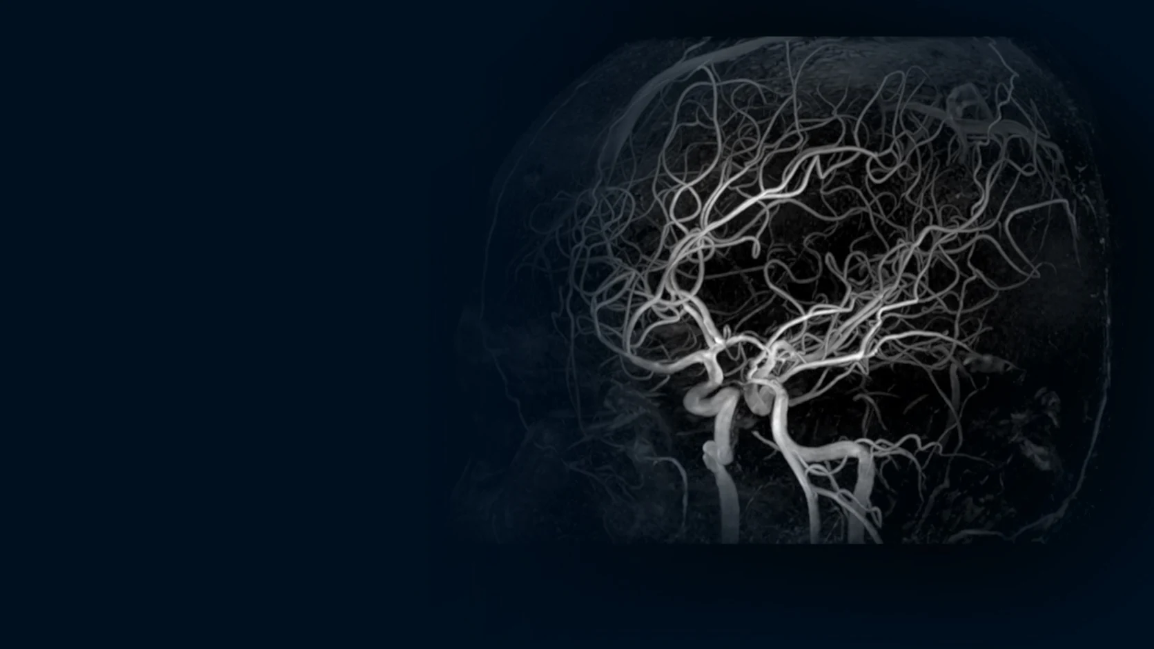 Angiografía cerebral obtenida con resonancia magnética de 5 teslas.