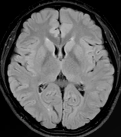 Resonancia cerebral a 3T en secuencia FLAIR.