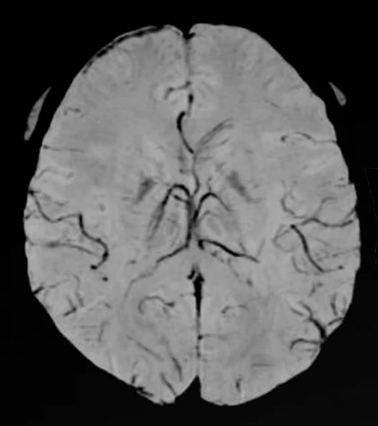 Resonancia cerebral a 3T en secuencia SWI.
