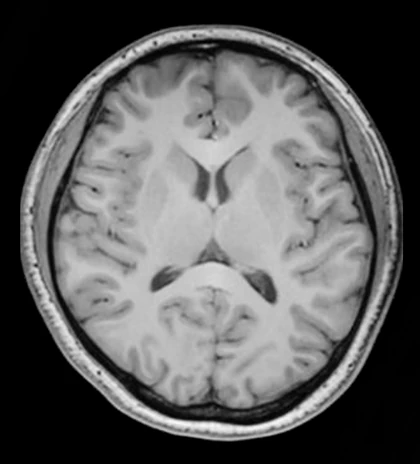 Resonancia cerebral a 3T en secuencia T1.