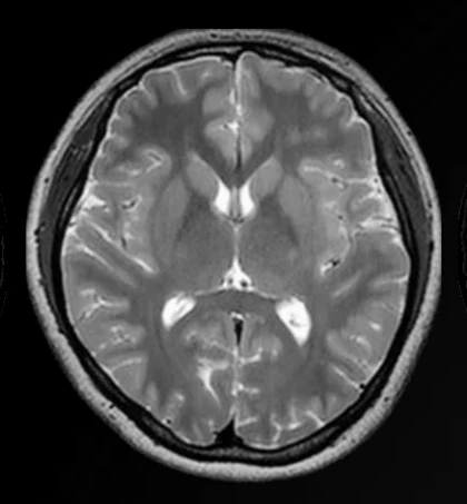 Resonancia cerebral a 3T en secuencia T2.