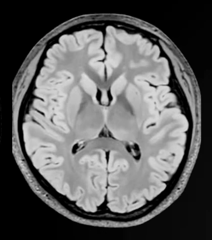 Resonancia cerebral a 5T en secuencia FLAIR.