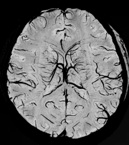 Resonancia cerebral a 5T en secuencia SWI.
