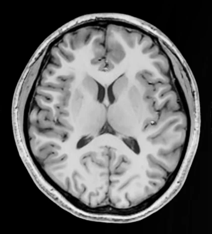 Resonancia cerebral a 5T en secuencia T1.