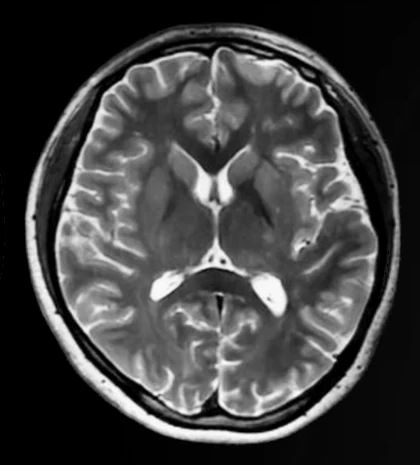 Resonancia cerebral a 5T en secuencia T2.